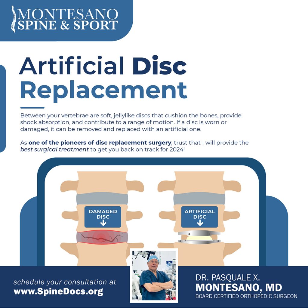 As one of the pioneers of disc replacement surgery, Dr. Pasquale X. Montesano will provide exceptional Artificial Disc Replacement surgery.