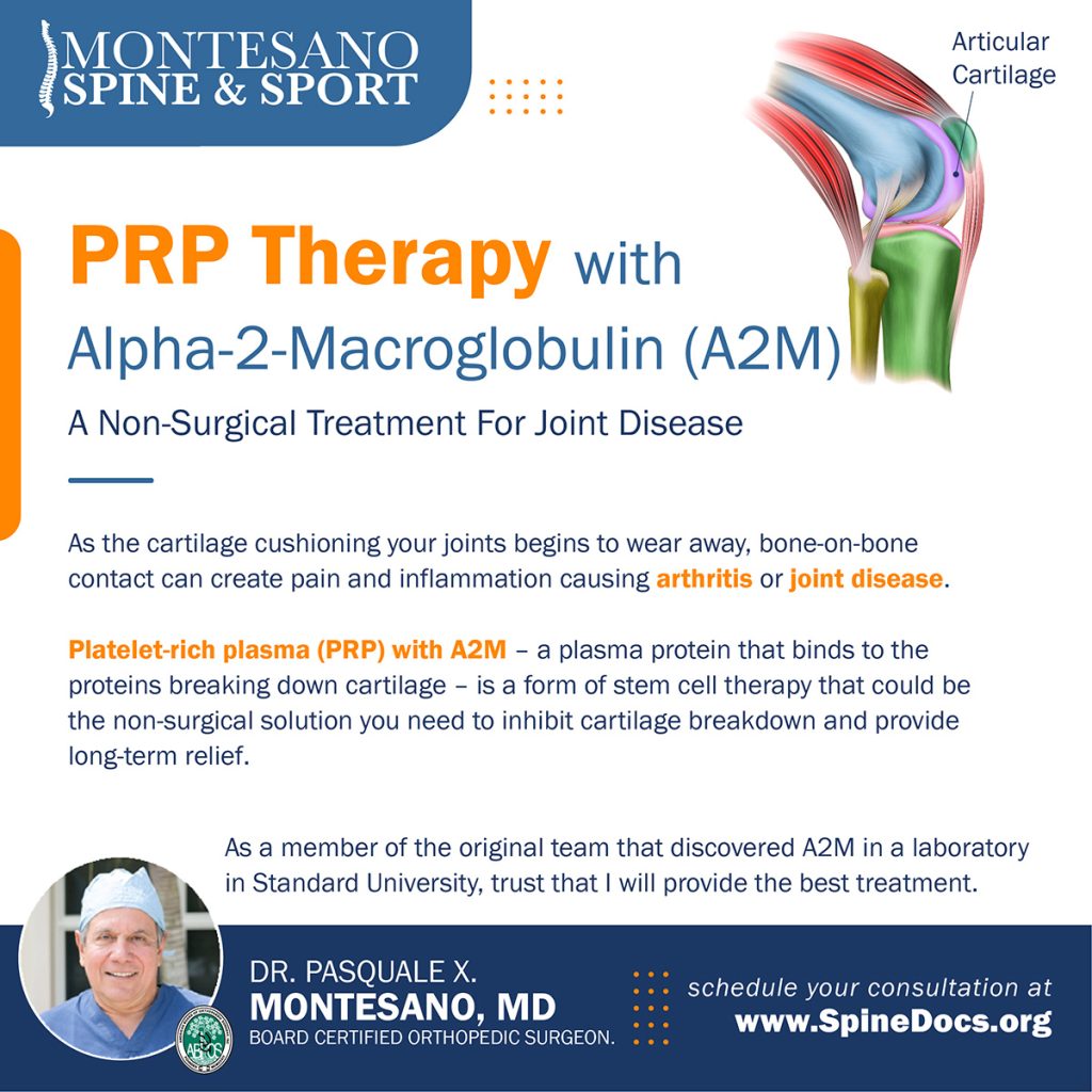 PRP with Alpha-2-Macroglobulin (A2M) could be the solution you need to inhibit cartilage breakdown and provide long-term relief.
