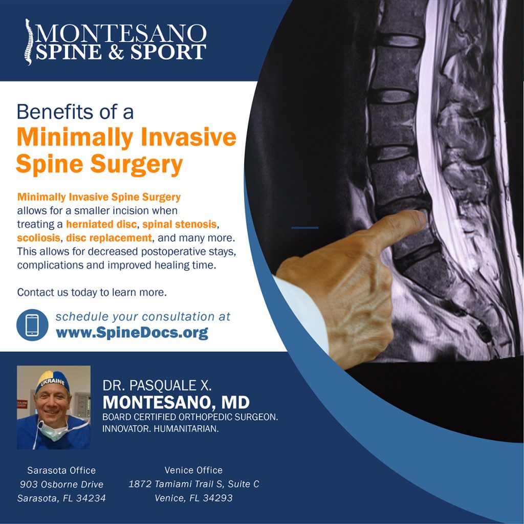 Minimally Invasive Spine Surgery allows for a smaller incision when treating herniated disc, spinal stenosis, disc replacements, and more.