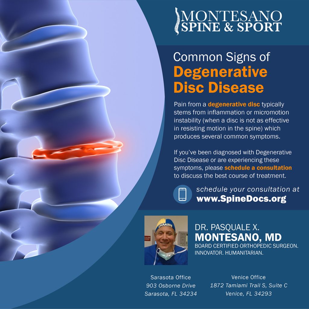 Here are several common signs of degenerative disc disease.