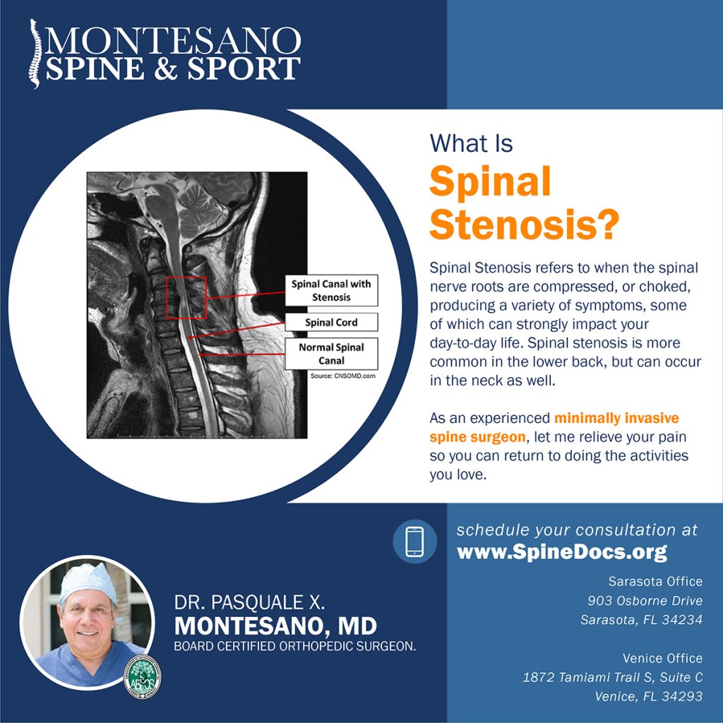 Spinal stenosis is more common in the lower back, but can occur in the neck as well. So what is spinal stenosis?