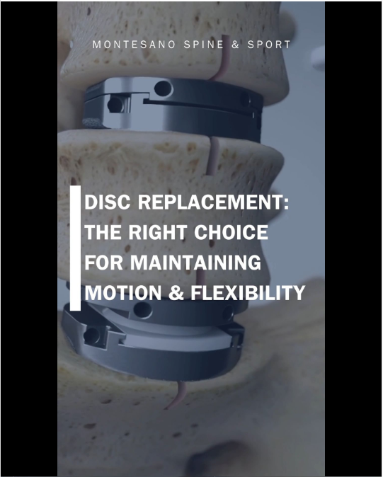 Read more about the article Benefits of Disc Replacement