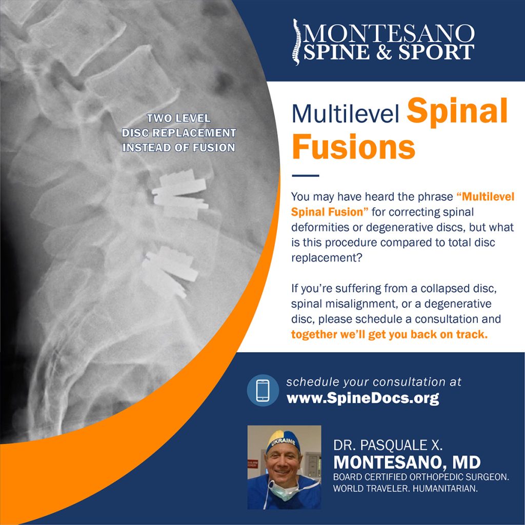 You may have heard the phrase “Multilevel Spinal Fusion” for correcting spinal deformities or degenerative discs, but what is it?