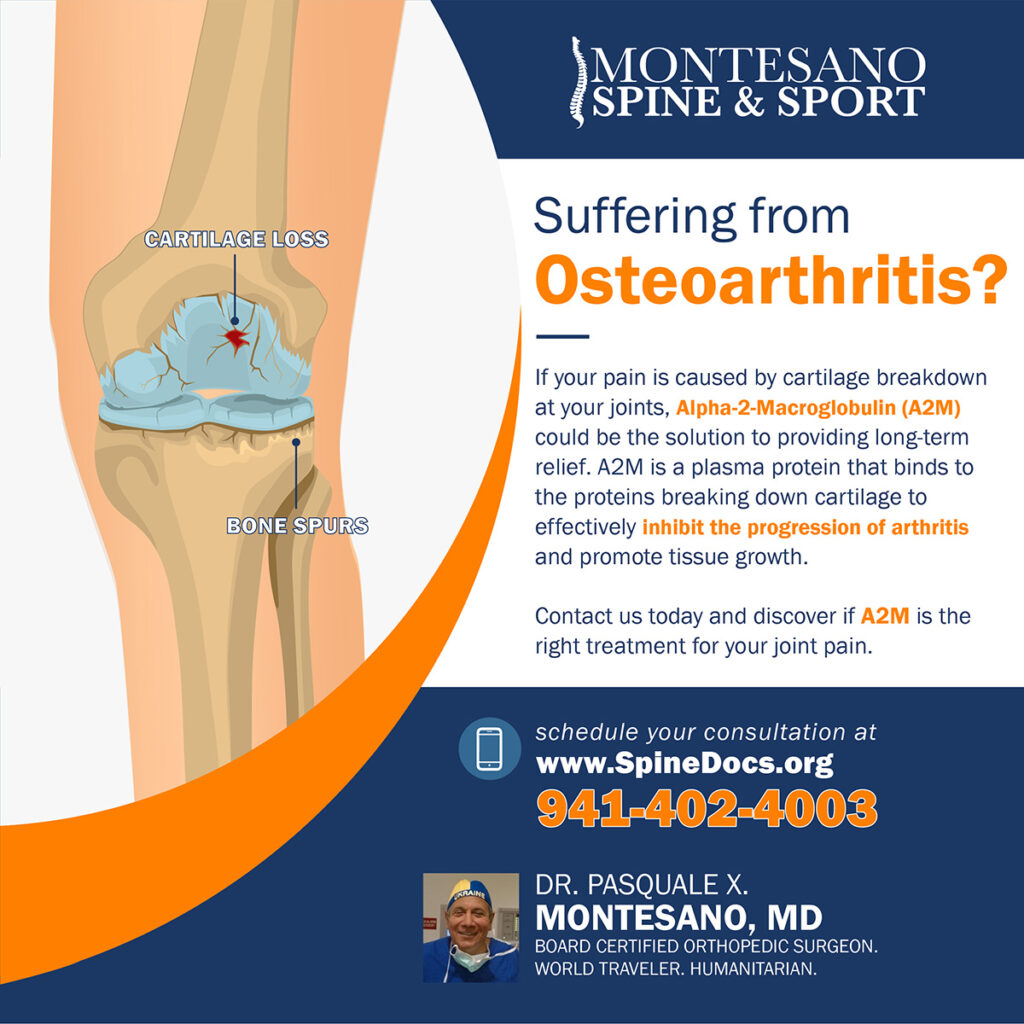 Osteoarthritis can cause stiffness, swelling, and pain. Alpha-2-Macroglobulin (A2M) could be the treatment you need.