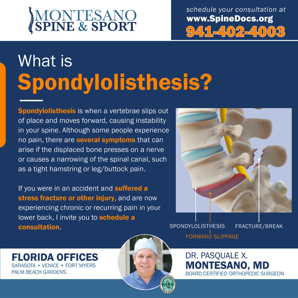 Learn about Spondylolisthesis, what symptoms can arise, and how it can be treated. Montesano Spine and Sport.