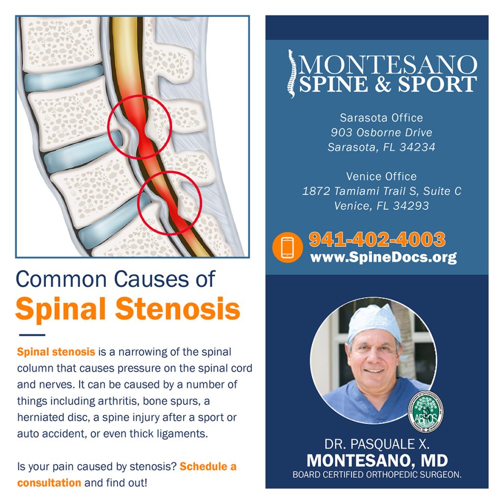 Explore common causes of spinal stenosis.