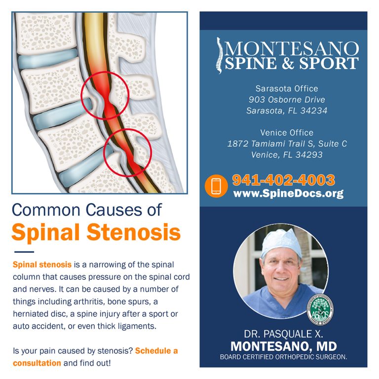 Read more about the article Common Causes of Spinal Stenosis