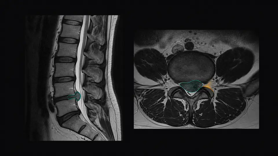 Sagittal and axial MRI views showing a lumbar herniated disc